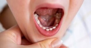 5 طرق سحرية للتخلص من آلام الأسنان