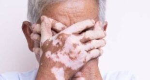 هل تعاني من تصبغ جلدك؟ وما هو البهاق البهاق؟