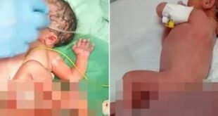 طفلة تولد بورم نادر بغزة.. صرخة حياة تصبح شاهدا على الكارثة الإنسانية